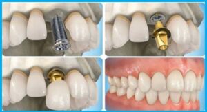 răng sứ implant bị vỡ - nguyên nhân và cách khắc phục
