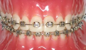 Metal braces