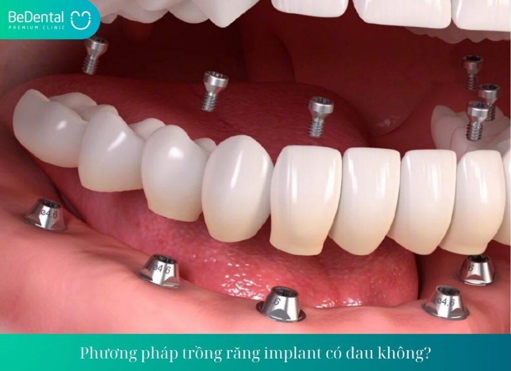 Phương pháp trồng răng implant có đau không?