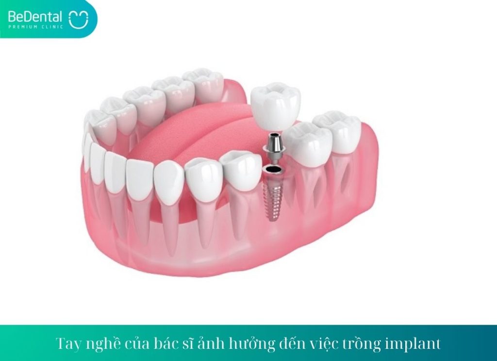 Phương pháp trồng răng implant có đau không?