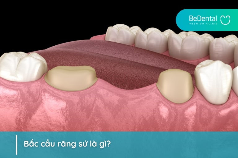 Bắc cầu răng sứ giúp phục hình thẩm mỹ với những trường hợp mất một hay nhiều chiếc răng thông qua việc tạo cầu nối giữa hai răng bên cạnh vị trí không còn răng
