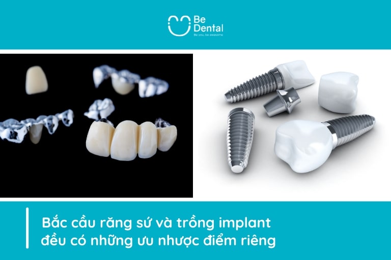 Bắc Cầu Răng Sứ Là Gì? So Sánh Cấy Răng Implant Và Cầu Răng Sứ 5 bac cau rang su la gi 4
