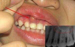 răng bị u nang chân răng có nguy hiểm không