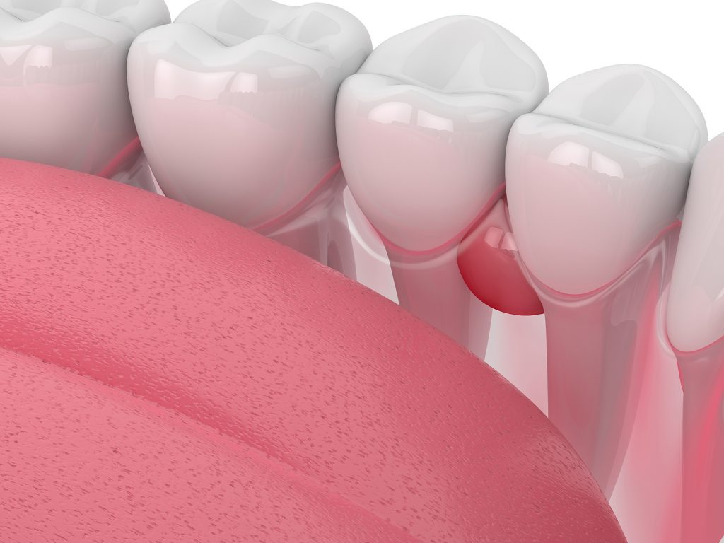 nang chân răng là gì