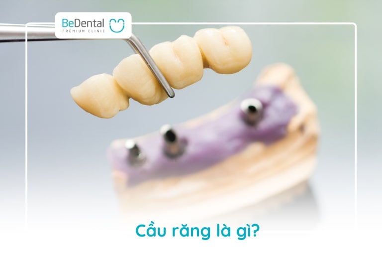 Cầu răng là phương pháp phục hình thẩm mỹ mất răng đã mất bằng các nhịp cầu từ 2, 3, 4 răng gắn liền với nhau