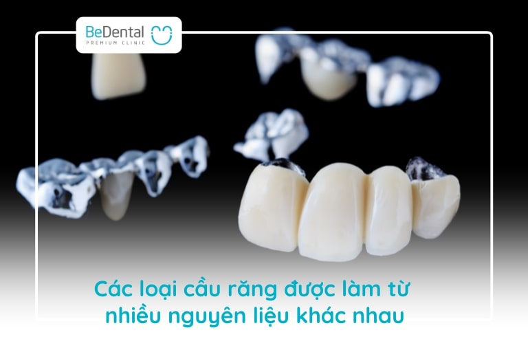 Các loại cầu răng có thể được làm từ kim loại, sợi thủy tinh,...