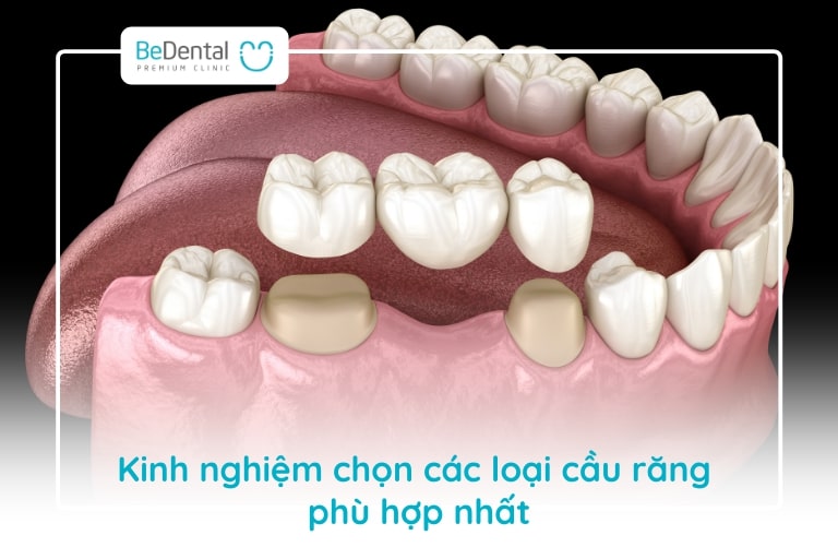 Bạn nên dựa vào tài chính, nhu cầu lẫn tình trạng răng hiện tại để chọn ra loại cầu răng phù hợp