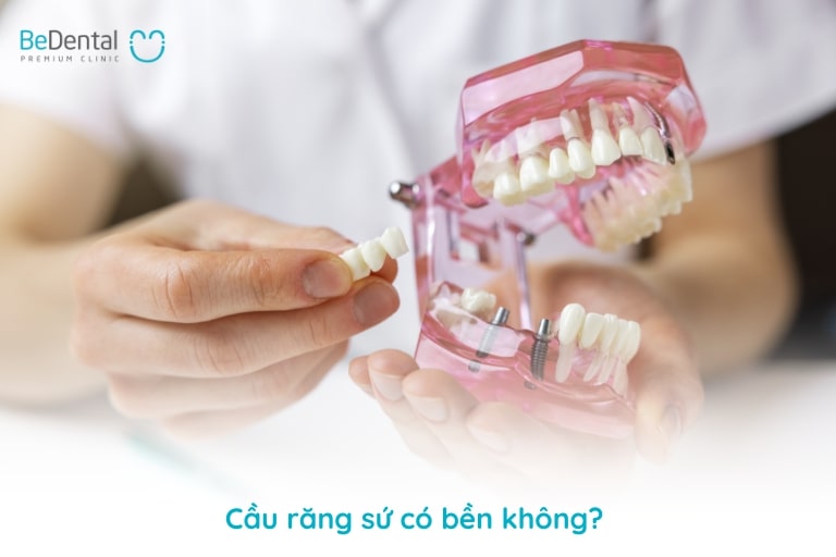 Cầu răng sứ có bền không phụ thuộc vào rất nhiều yếu tố như chất lượng cùi răng, mão sứ, tay nghề bác sĩ và cách chăm sóc