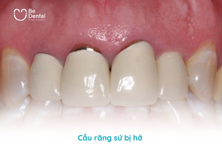 Cầu răng sứ bị hở xảy ra khá phổ biến