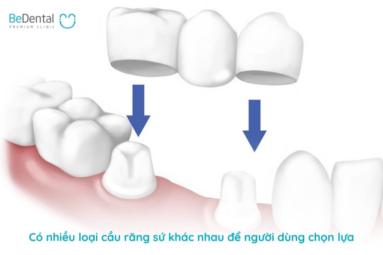 Có nhiều loại cầu răng khác nhau như cầu răng nhảy, cầu răng cánh dán, cầu răng truyền thống,...