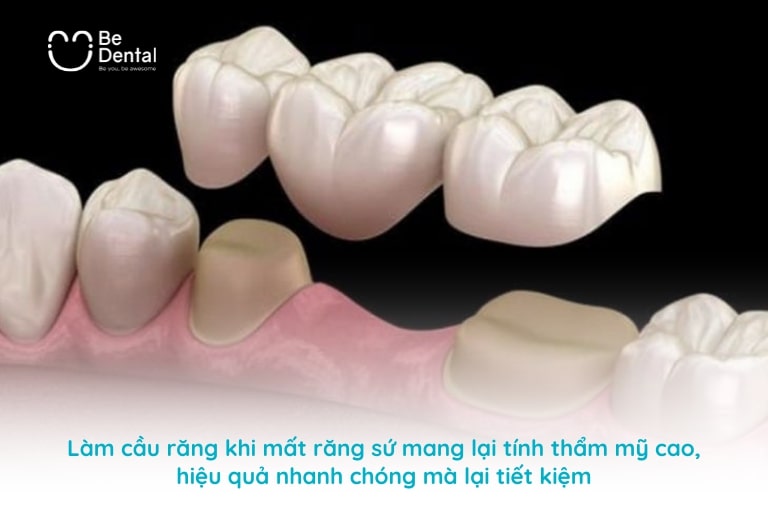 Ưu điểm của cầu răng so với các phương pháp phục hình thẩm mỹ khác