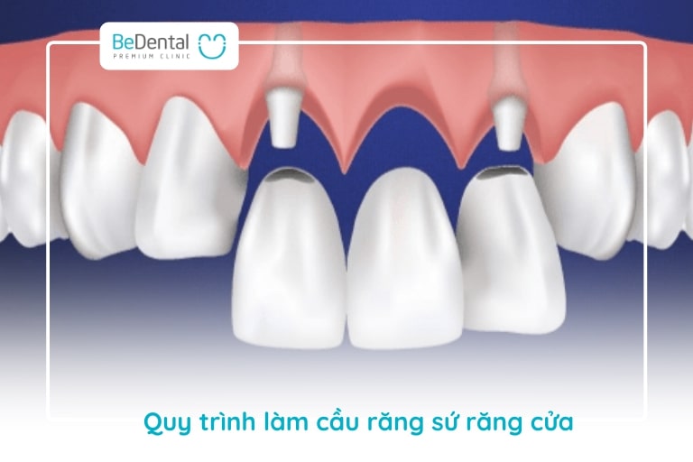 Quy trình làm cầu răng cho răng cửa cần phải cẩn thận từng bước thăm khám đến mài cùi, lấy dấu mẫu hàm,...