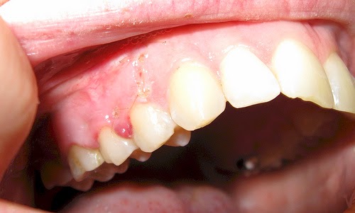 Các triệu chứng của u nang răng