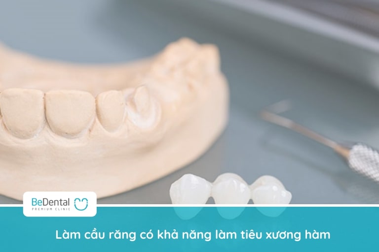 Làm cầu răng có bị tiêu xương không?