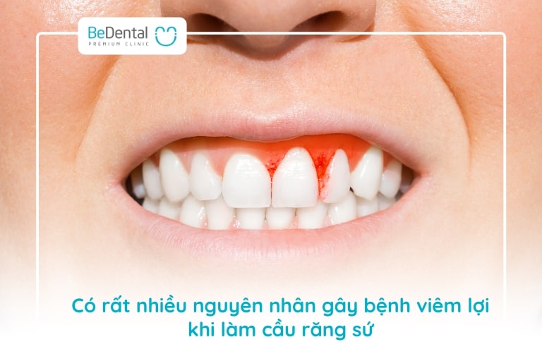 Làm cầu răng sứ hay bị viêm lợi do rất nhiều nguyên nhân gây ra