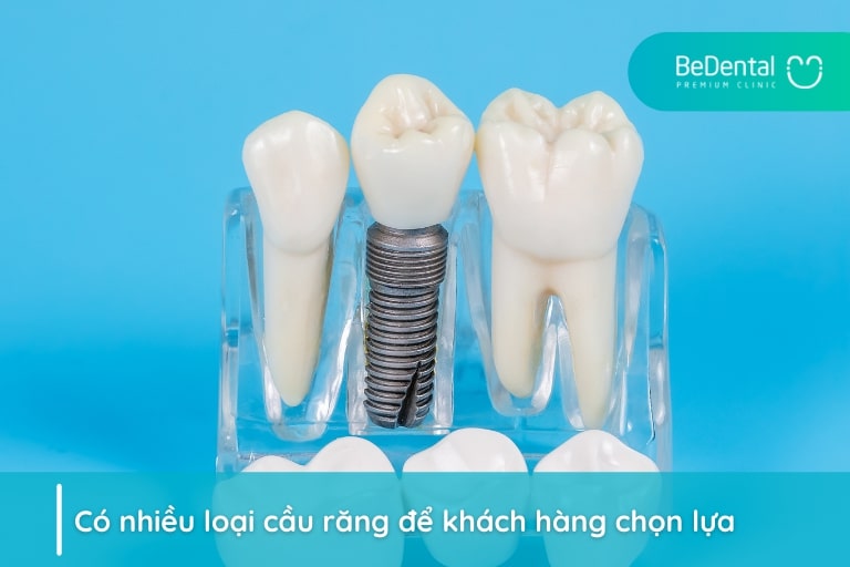Có nhiều loại cầu răng phù hợp với vị trí răng hàm số 5, 6, 7