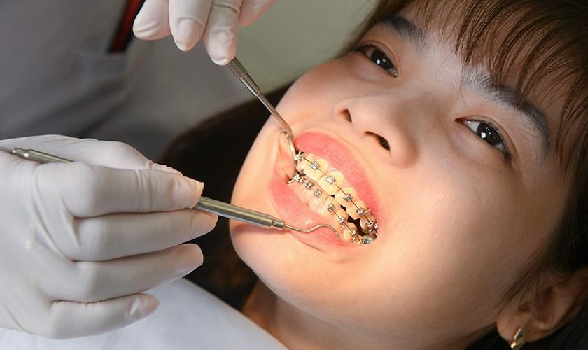 niềng răng không mắc cài có hiệu quả không