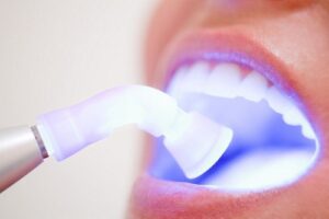 nguyên nhân gây ra tình trạng ê buốt răng sau khi tẩy trắng