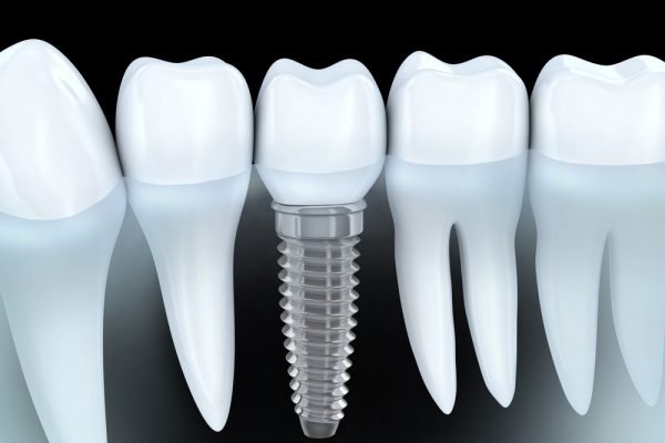 răng sứ Implant bị vỡ