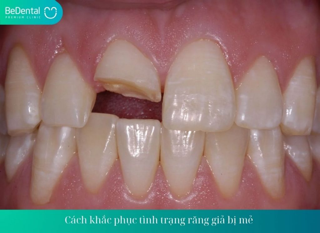 Cách khắc phục tình trạng răng giả bị mẻ