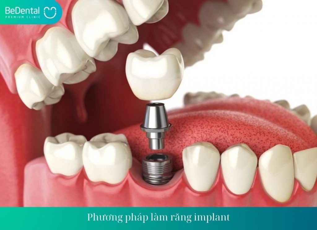 Phương pháp làm răng implant