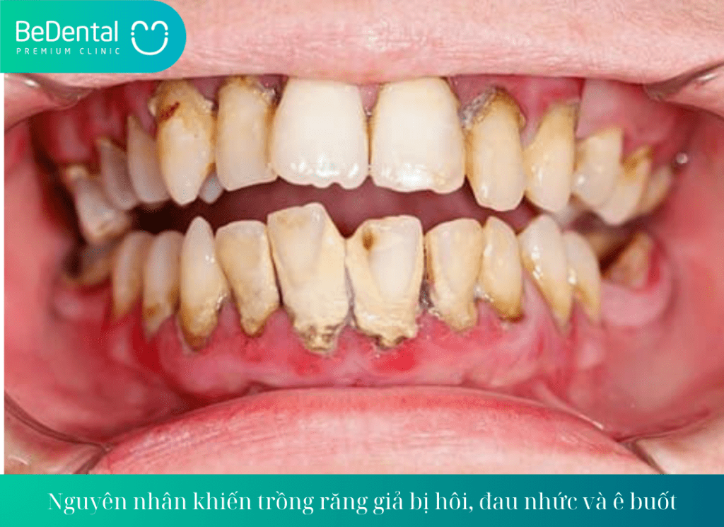 Nguyên nhân khiến trồng răng giả bị hôi, đau nhức và ê buốt