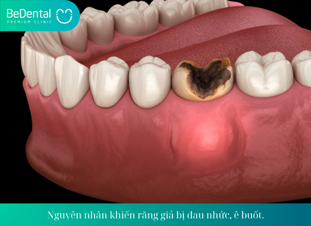 Nguyên nhân khiến răng giả bị đau nhức, ê buốt.