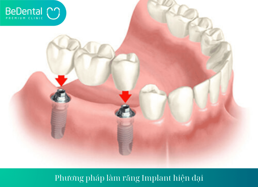 Làm răng Implant khắc phục các vấn đề về răng giả bị hôi, đau nhức, ê buốt,...