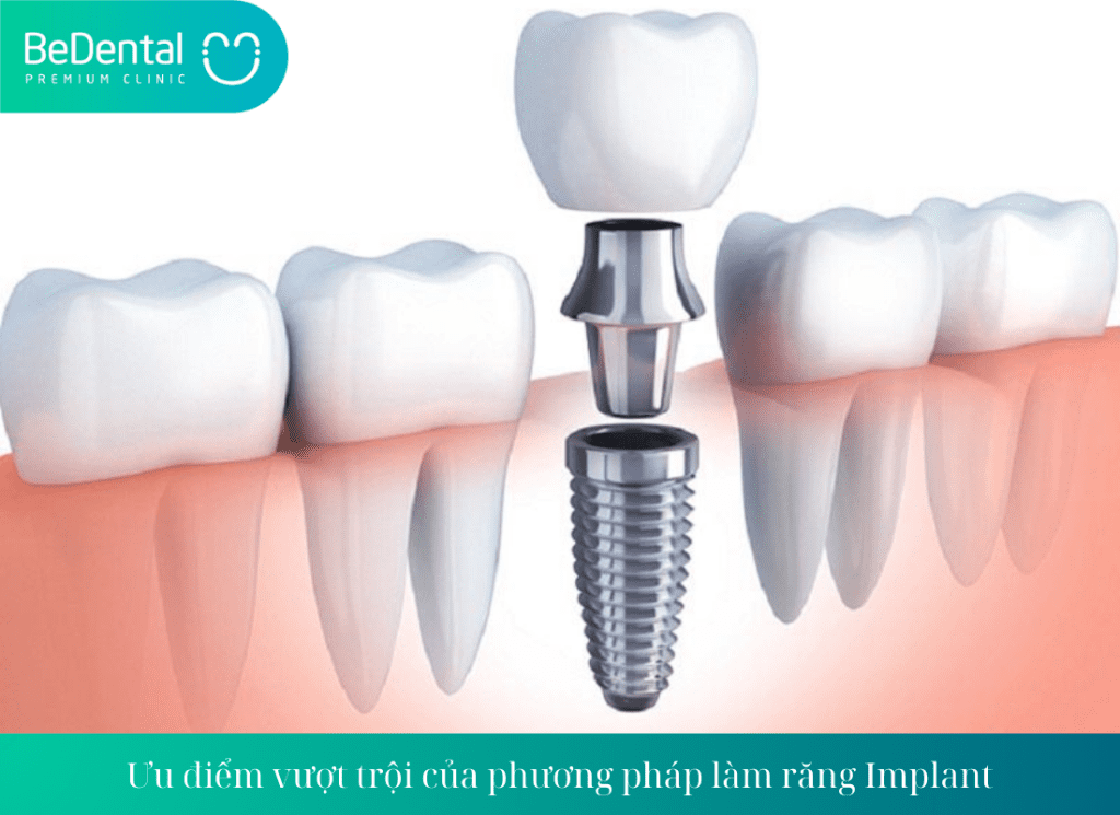 Ưu điểm vượt trội của làm răng Implant tráng việc răng giả bị hôi