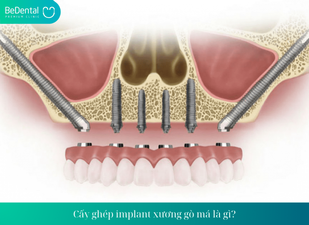 Cấy ghép implant xương gò má là gì?