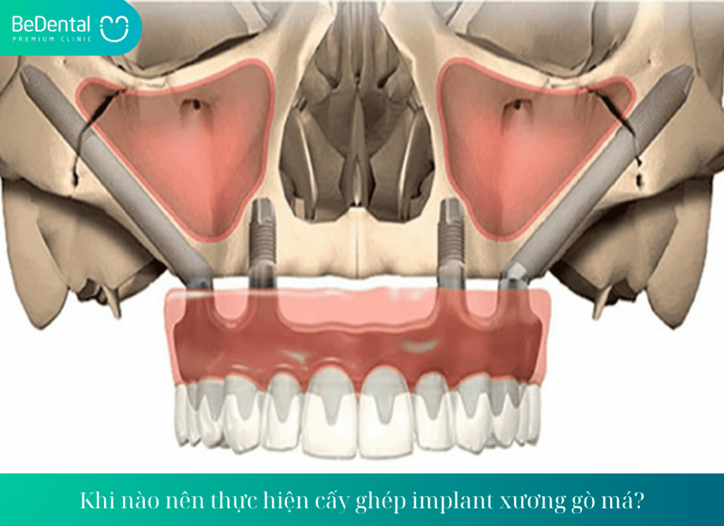 Khi nào nên thực hiện cấy ghép implant xương gò má?