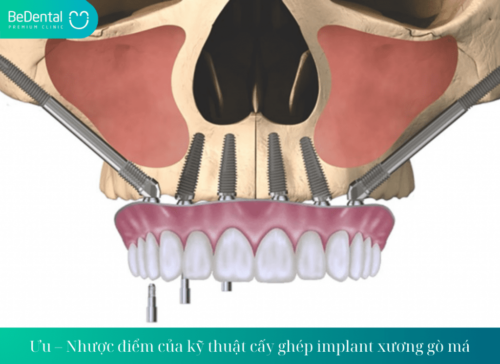 Ưu – Nhược điểm của kỹ thuật cấy ghép implant xương gò má