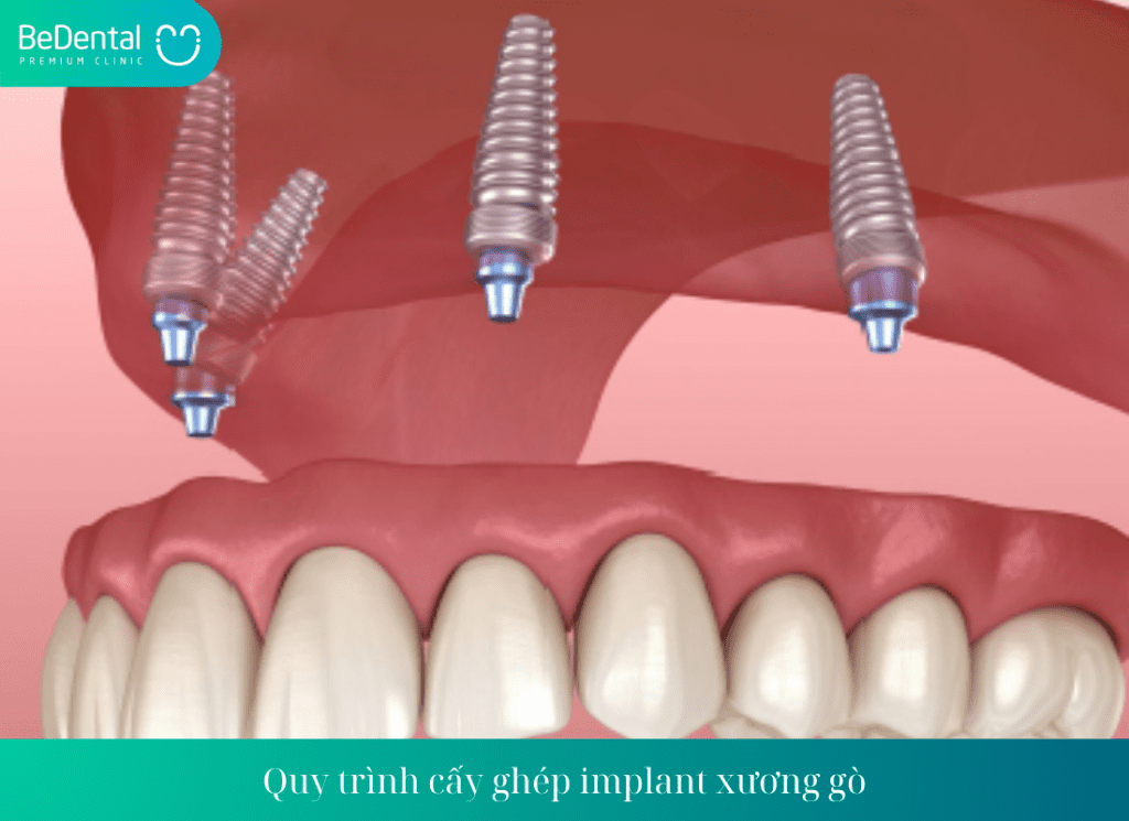 Quy trình cấy ghép implant xương gò má diễn ra như thế nào?