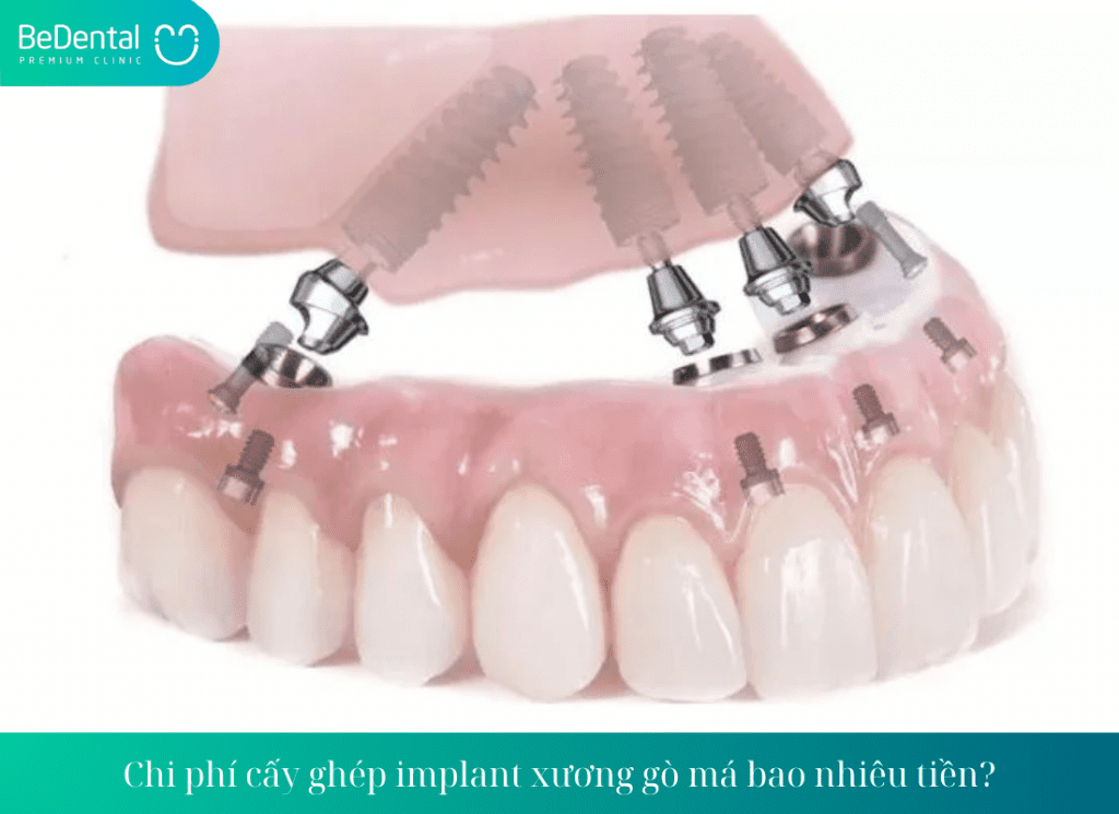 Chi phí cấy ghép implant xương gò má bao nhiêu tiền?