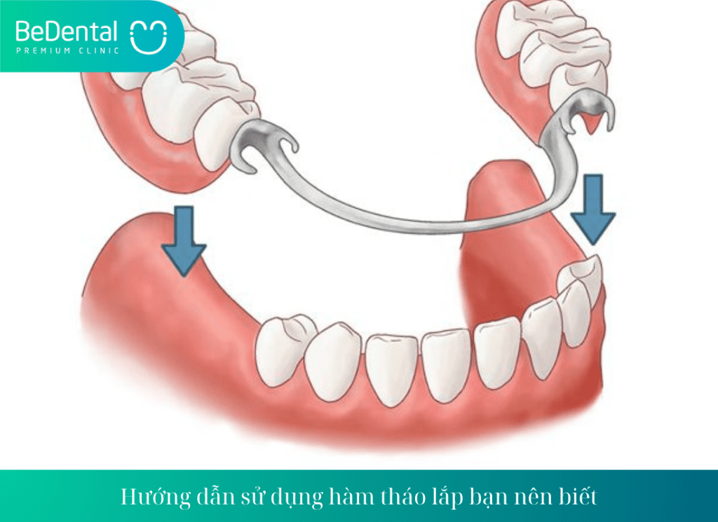 Sử dụng hàm tháo lắp không cầu kỳ nhiều bước, bạn có thể tự làm ngay tại nhà