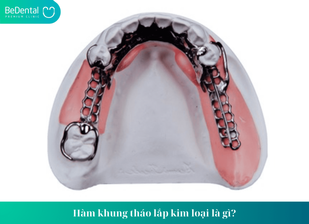 Hàm khung tháo lắp kim loại là gì?