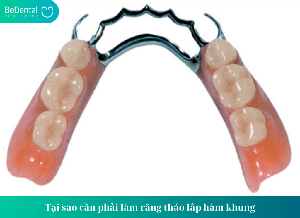 Tại sao cần phải làm răng tháo lắp hàm khung