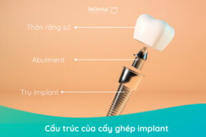 Cấu trúc của cấy ghép implant - Mất răng lâu năm