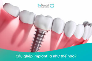 Mất răng lâu năm - Cấy ghép implant là như thế nào?