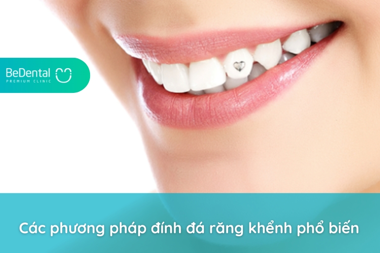 Có hai phương pháp đính đá răng khểnh phổ biến nhất