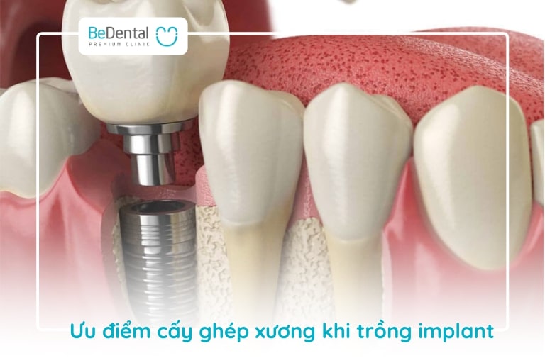 Cấy ghép xương răng khi trồng implant sẽ giúp ổn định trụ, tái tạo xương hàm, bảo tồn răng thật,...