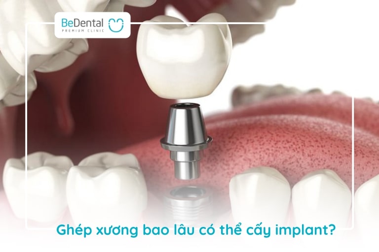 Thường đặt trụ implant sẽ diễn ra sau 9 – 12 tháng cấy ghép xương răng