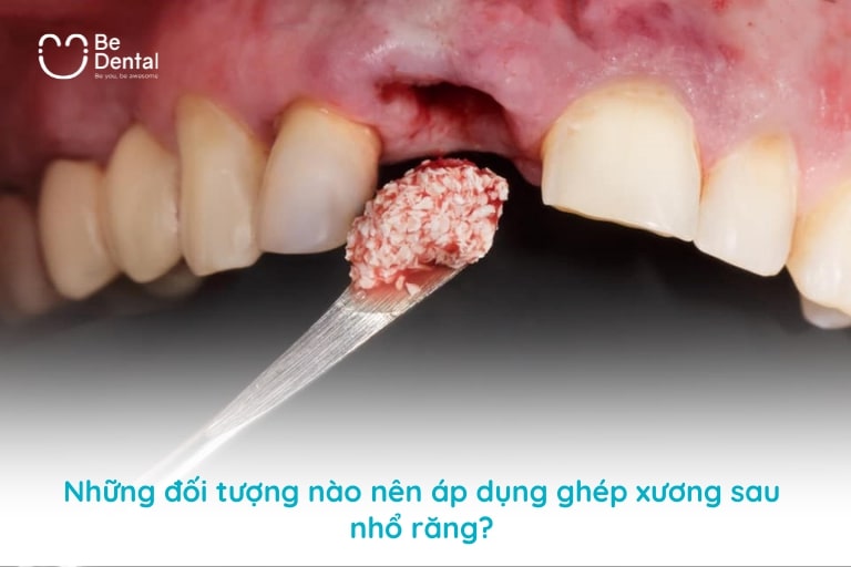 Những người mất răng lâu năm, mô xương yếu, sử dụng hàm tháo lắp lâu,... nên ghép xương sau khi nhổ