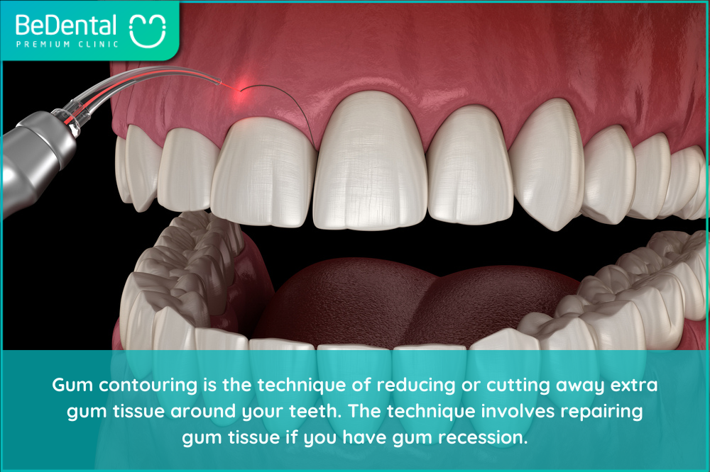 GUM CONTOURING – DOES IT HURT AND HOW MUCH DOES IT COST? – Be Dental