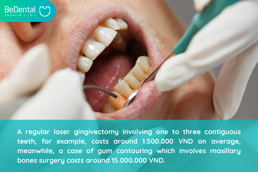 GUM CONTOURING DOES IT HURT AND HOW MUCH DOES IT COST? Be Dental
