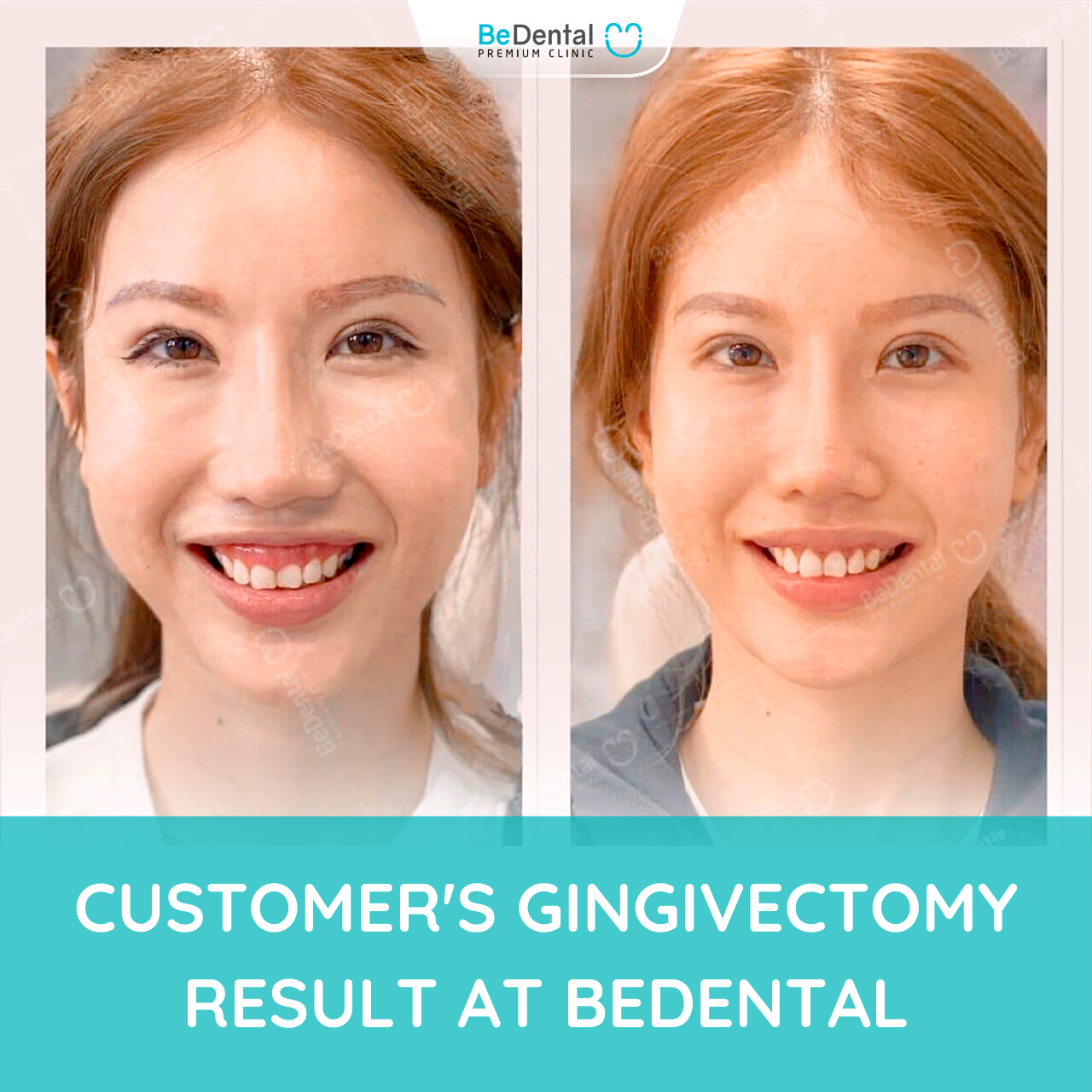 GUM CONTOURING DOES IT HURT AND HOW MUCH DOES IT COST? Be Dental
