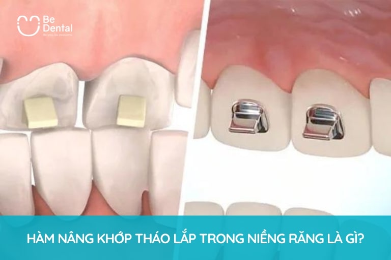 Hàm Nâng Khớp Tháo Lắp Trong Niềng Răng Là Gì?