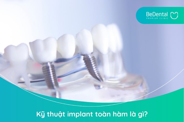 Implant toàn hàm là phương pháp phục hình thẩm mỹ mất răng với những người bệnh mất toàn bộ răng một hàm hoặc 2 hàm