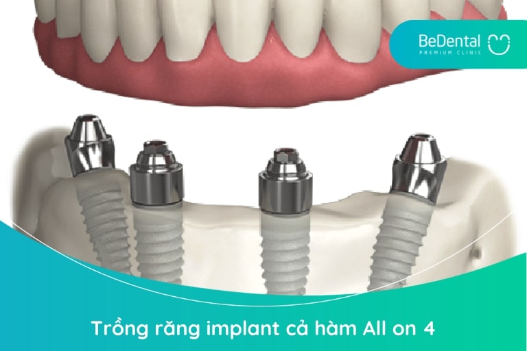 Trồng răng implant cả hàm All on 4