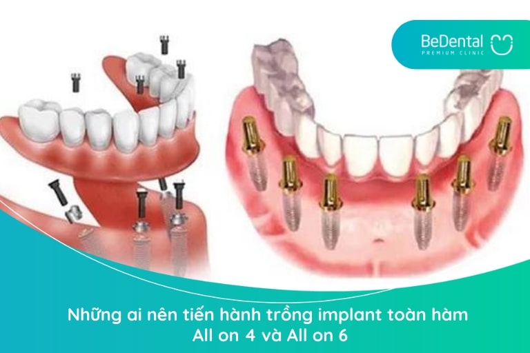 Những người mất nhiều răng từ 6 chiếc trở lên, mất răng toàn hàm, viêm nha chu nặng,... nên tham khảo trồng implant toàn hàm